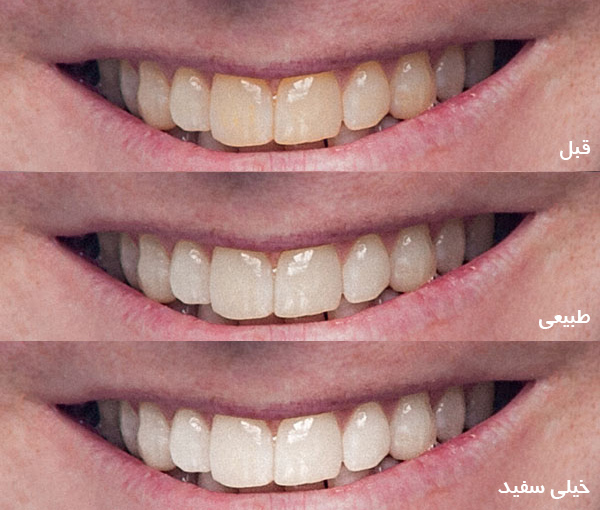 whitening-teeth-in-photoshop-06